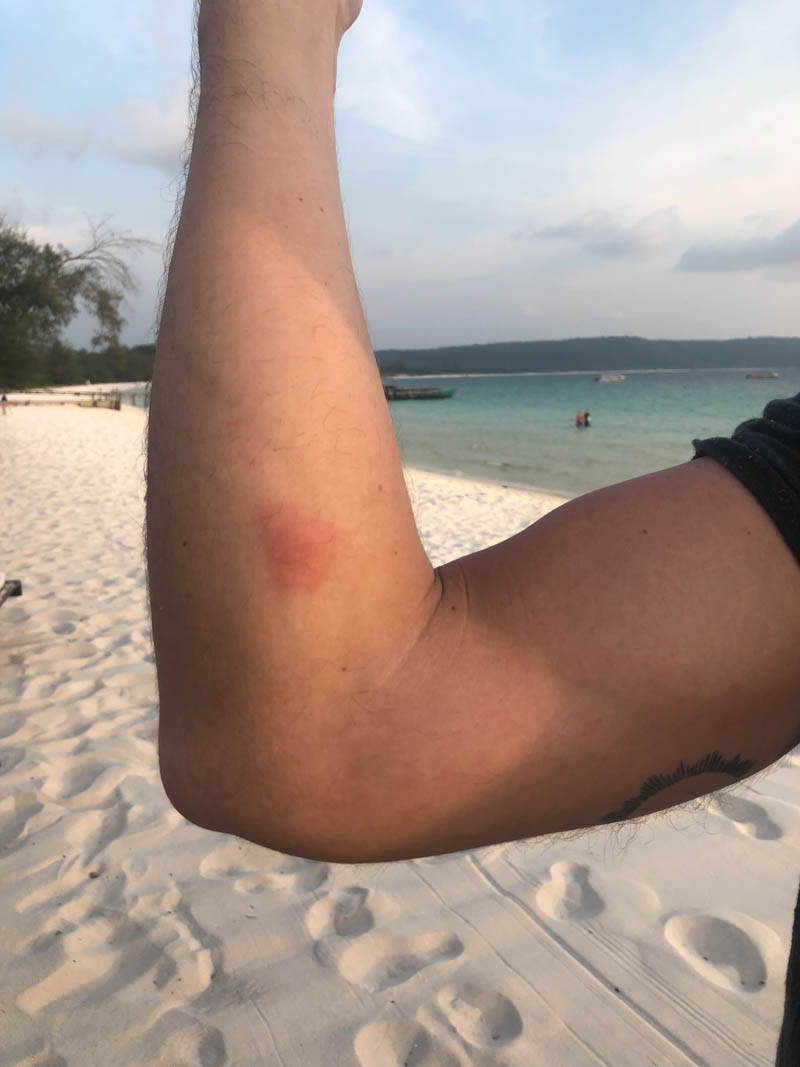 Unsightly sand flea bites from Captiva beach. Painful and
