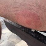 Sandfly bite Strong allergic reaction