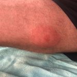 Sandfly bite allergic reaction