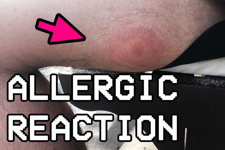 Sandfly bite allergic reaction